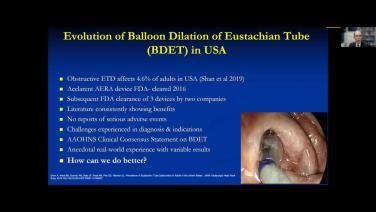 An Image From "The Evolution of Eustachian Tube Dilation, Dennis Poe MD"
