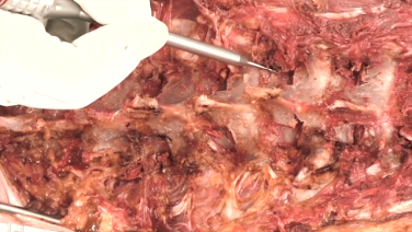 Pedicle Screw Placement in Pediatric Deformity with Suken Shah, MD thumbnail iamge