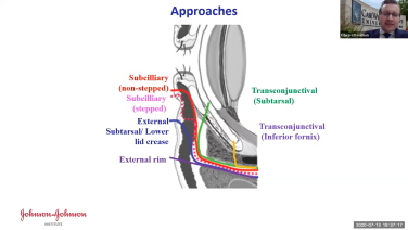 An image from the "Concepts in Orbital Reconstruction: Approaches with Edward Davidson, MD" video on the JnJInstitute.com website.