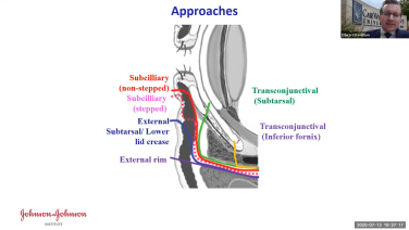 An image from the "Concepts in Orbital Reconstruction: Approaches with Edward Davidson, MD" video on the JnJInstitute.com website.