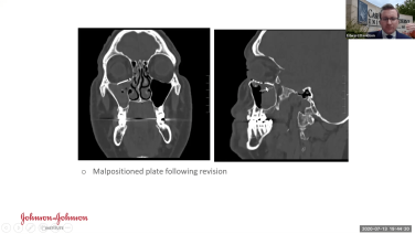 An image from the "Concepts in Orbital Reconstruction: Established Post-traumatic Globe Malposition with Edward Davidson, MD" video on the JnJInstitute.com website.