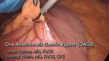 An Image From "One Anastomosis Gastric Bypass (OAGB) with James Dasher, MD and Thomas Walsh, MD"
