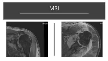 Thumbnail image of Global Unite Shoulder System: Case Review with Hafiz Kassem, MD