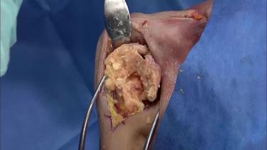 Thumbnail Image ofGLOBAL UNITE Reverse Shoulder Fracture: Tuberosity Management with Carl Basamania, MD