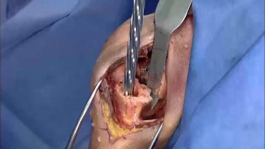 Thumbnail image of GLOBAL UNITE Reverse Shoulder Fracture: Humeral Reaming with Carl Basamania, MD