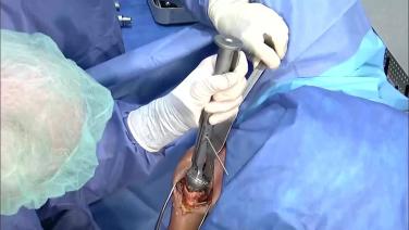 Thumbnail image of GLOBAL UNITE Reverse Shoulder Fracture: Trial Assembly with Carl Basamania, MD