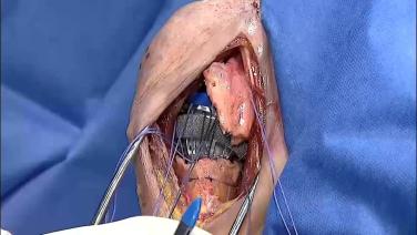 thumbnail image of GLOBAL UNITE Reverse Shoulder Fracture: Suture Technique with Carl Basamania, MD