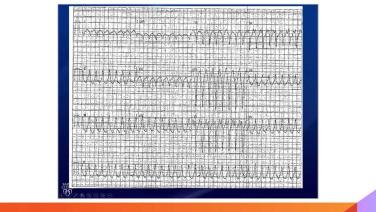 An Image From "Essentials of EP 2023 Case Examples With Samuel Asirvatham, MD"