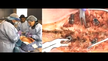 Pedicle Subtraction Osteotomy with Suken Shah, MD, Barron Lonner, MD & Randal Betz, MD thumbnail image