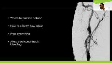 An Image From "Benefits of Flow Arrest – Stroke & Beyond"