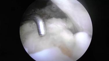 Posterolateral Corner Reconstruction using the Mitek Sports Medicine Knee Portolio with Dean Wang, MD thumbnail image