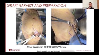 Quad Tendon ACL Reconstruction: Graft Harvest & Preparation - Justin Ernat, MD thumbnail