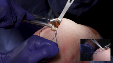 All-Inside ACLR using Quad Tendon: Graft Harvest with Justin Ernat, MD thumbnail image