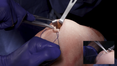 All-Inside ACLR using Quad Tendon: Graft Harvest with Justin Ernat, MD thumbnail image