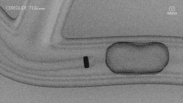 An image from "CEREGLIDE™ 71 with TruCourse™ Instructions for Use Video"