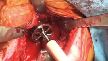 Revision Shoulder Arthroplasty Extraction Instrumentation: Case 1 with Bal MD