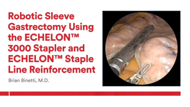 An Image From "Robotic Sleeve Gastrectomy Using the ECHELON 3000 Stapler and ECHELON Staple Line Reinforcement with Brian Binetti, MD"