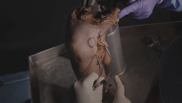 Shoulder Arthroplasty Procedural Workflow: Anatomic Total Shoulder Series thumbnail image