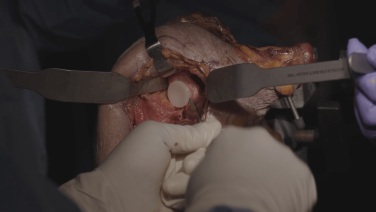 INHANCE Shoulder System: Instrumentation and Implant Review with Anand Murthi, MD thumbnail image