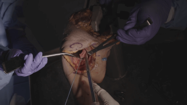 Anatomic Total Shoulder Arthroplasty: Implant Removal for Revision to Anatomic with Anand Murthi, MD thumbnail image