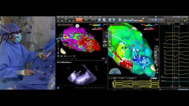 An Image From "Techniques for Substrate Mapping Ischemic VT with the OPTRELL Mapping Catheter"