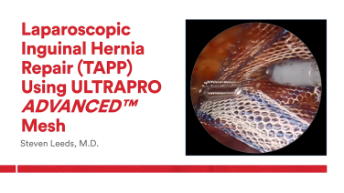 An IMage From "Laparoscopic Inguinal Hernia Repair (TAPP) using ULTRAPRO ADVANCED Mesh with Steven Leeds, MD"