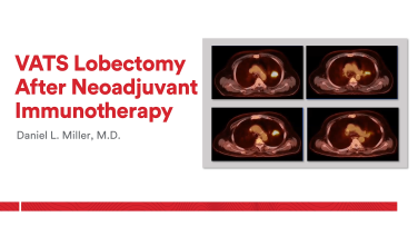 An Image From "VATS Lobectomy After Neoadjuvant Immunotherapy with Daniel Miller, MD"