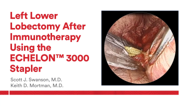 An image from " Left Lower Lobectomy After Immunotherapy Using the ECHELON 3000 Stapler with Scott Swanson, M