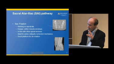 SAI Fixation Techniques with Paul Sponseller, MD thumbnail