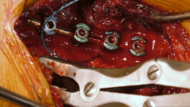 Lateral Mass Exposure with Victor Chang