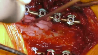 Spinal Cord Exposure, Bone Graft Placement & Final Closure with Victor Chang, MD thumbnail image