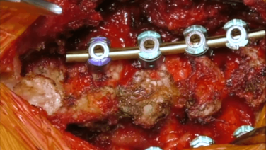 Cervical Laminectomy & Fusion with Victor Chang, MD thumbnail