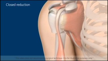 An Image From "Proximal Humerus Percutaneous Animation"