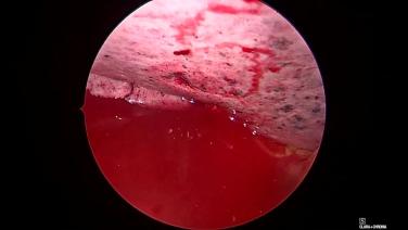 Thorascopic Lobectomy - Air Leak Test