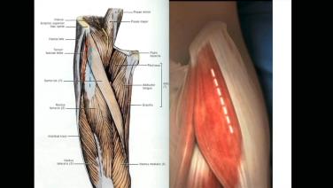 ANTERIOR ADVANTAGE™ THA with Hana® Table Functional Anatomy for Anterior Approach with Tania Ferguson, MD