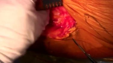ANTERIOR ADVANTAGE™ THA with Hana® Table Procedural Workflow with Joel Matta, MD 