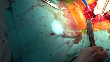 Aortic Valve Replacement (AVR) - Closure
