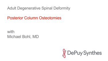 Adult Degenerative Spinal Deformity Technique Steps with Michael Bohl, MD