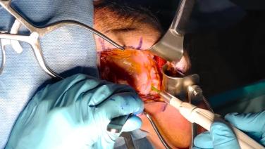 INHANCE INTACT Tissue Sparing Technique: Anatomic Stemless Procedure Workflow with Daniel Hackett, MD