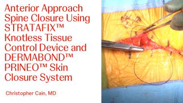 Anterior Approach Spine Closure Using STRATAFIX™ Knotless Tissue Control Device and DERMABOND™ PRINEO™ Skin Closure System with Christopher Cain, MD
