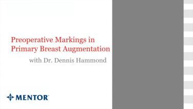 An Image From "Preoperative Markings in Primary Breast Augmentation - Dennis Hammond, MD"