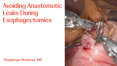 An Image From "Avoiding Anastomotic Leaks During Esophagectomies with Olugbenga Okusanya, MD"