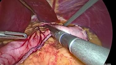 An Image From "Higa Narrated Laparoscopic Sleeve Gastrectomy with Echelon +"