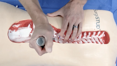 Adult Degenerative Spinal Deformity Technique Steps with Michael Bohl, MD