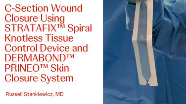 An image of the "C-Section Wound Closure using STRATAFIX and Dermabond PRINEO 22 with Russell Stankiewicz, MD" video on the JnJInstitute.com website.