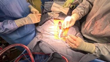 Coronary Artery Bypass Grafting (CABG) - Closure Sternum - Hemostasis