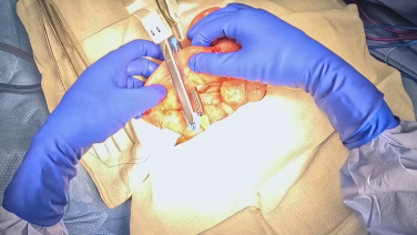 An Image From "Ileocolic Resection Using the ECHELON™ Linear Cutter with Katerina Wells, MD"