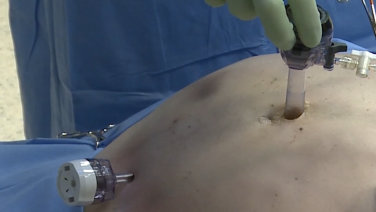 An Image From " Laparoscopic Left Colectomy and Low Anterior Resection in a Cadaver Model with David Longcope, MD"
