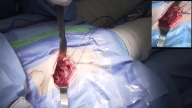 Off-Table DAA Live Surgery - Dr. Cameron Cooke