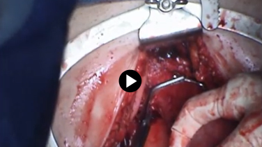 Total Abdominal Hysterectomy - Incise & Remove Uterus/Cervix